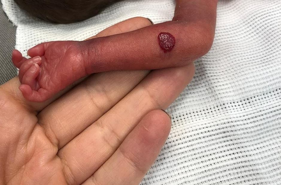 Braço de um recém-nascido com hemangioma infantil superficial, apoiado na mão de um adulto